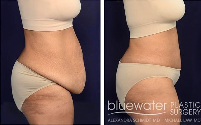 Tummy Tuck result at Blue Water Plastic Surgery Partners in Raleigh, NC