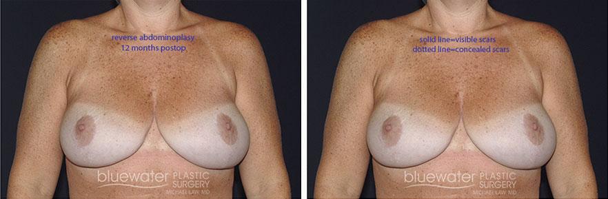 Blue Water Plastic Surgery Partners liposuction result — Raleigh, NC
