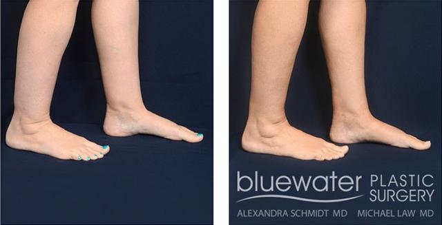 Liposuction result at Blue Water Plastic Surgery Partners in Raleigh, NC