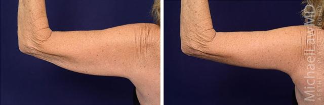 Arm Lift result at Blue Water Plastic Surgery Partners in Raleigh, NC