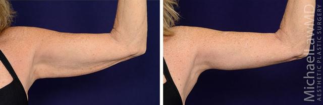Arm Lift result at Blue Water Plastic Surgery Partners in Raleigh, NC