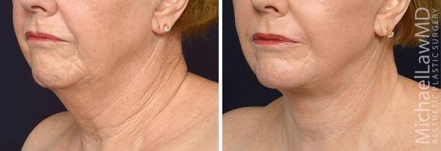 Fat Transfer result at Blue Water Plastic Surgery Partners in Raleigh, NC