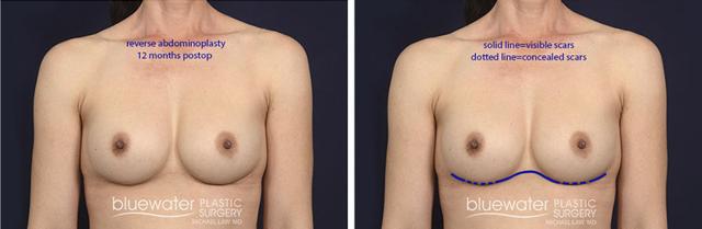 Brazilian Butt Lift result at Blue Water Plastic Surgery Partners in Raleigh, NC