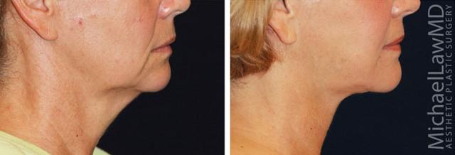 Neck Lift result at Blue Water Plastic Surgery Partners in Raleigh, NC