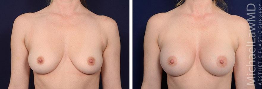 Blue Water Plastic Surgery Partners breast augmentation result — Raleigh, NC