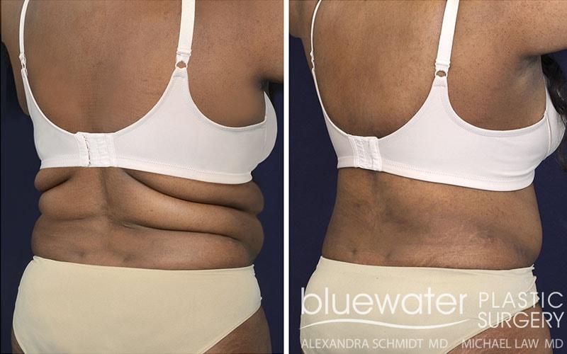 Blue Water Plastic Surgery Partners body lift result — Raleigh, NC