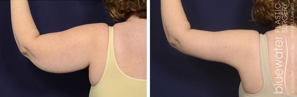 Blue Water Plastic Surgery Partners arm lift result — Raleigh, NC