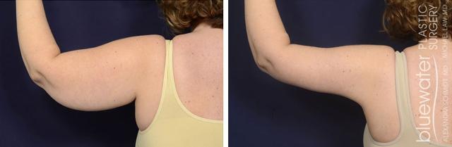 Arm Lift result at Blue Water Plastic Surgery Partners in Raleigh, NC