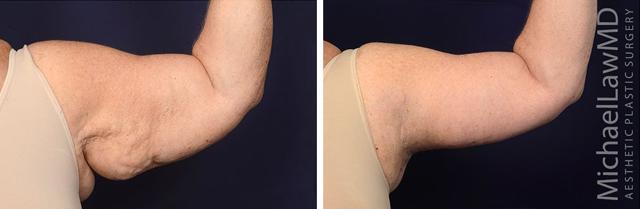 Arm Lift result at Blue Water Plastic Surgery Partners in Raleigh, NC