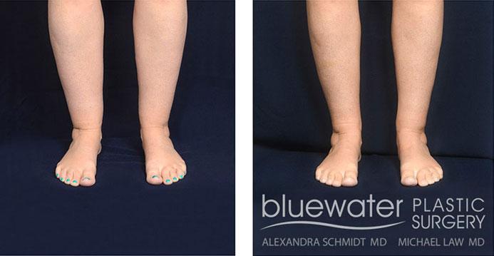 Blue Water Plastic Surgery Partners liposuction result — Raleigh, NC