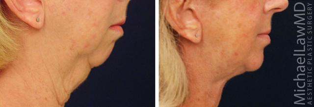 Neck Lift result at Blue Water Plastic Surgery Partners in Raleigh, NC