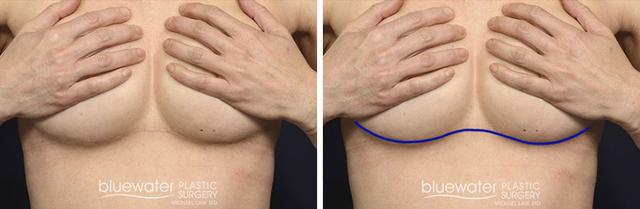Brazilian Butt Lift result at Blue Water Plastic Surgery Partners in Raleigh, NC