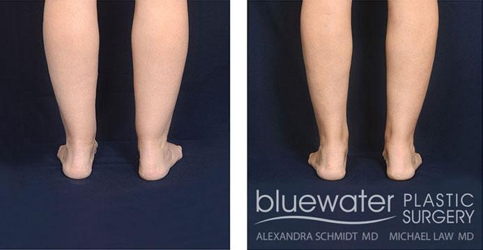 Blue Water Plastic Surgery Partners liposuction result — Raleigh, NC