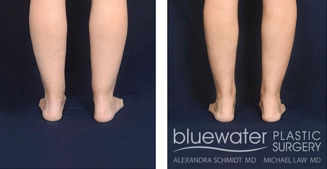 Brazilian Butt Lift result at Blue Water Plastic Surgery Partners in Raleigh, NC
