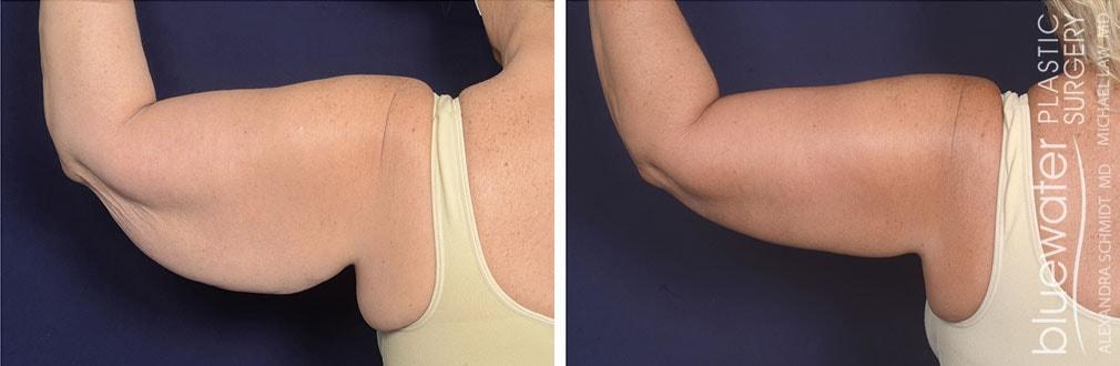 Blue Water Plastic Surgery Partners arm lift result — Raleigh, NC