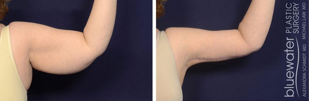 Blue Water Plastic Surgery Partners arm lift result — Raleigh, NC