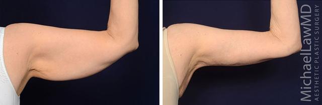 Arm Lift result at Blue Water Plastic Surgery Partners in Raleigh, NC