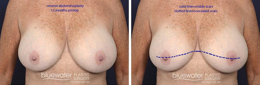 Blue Water Plastic Surgery Partners liposuction result — Raleigh, NC