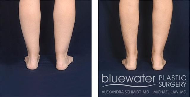 Liposuction result at Blue Water Plastic Surgery Partners in Raleigh, NC