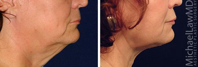 Neck Lift result at Blue Water Plastic Surgery Partners in Raleigh, NC