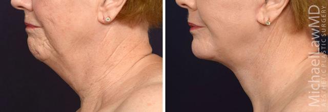 Fat Transfer result at Blue Water Plastic Surgery Partners in Raleigh, NC