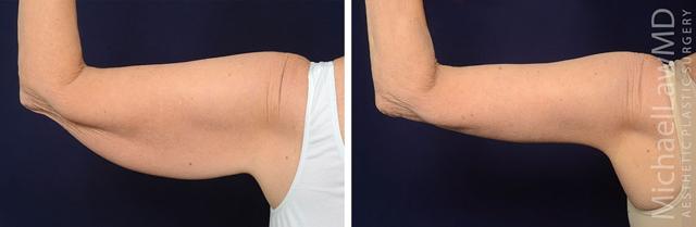 Arm Lift result at Blue Water Plastic Surgery Partners in Raleigh, NC
