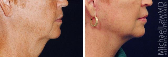 Neck Lift result at Blue Water Plastic Surgery Partners in Raleigh, NC