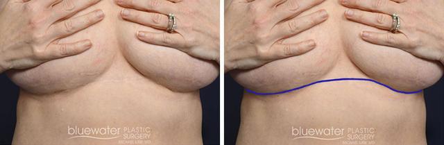 Brazilian Butt Lift result at Blue Water Plastic Surgery Partners in Raleigh, NC