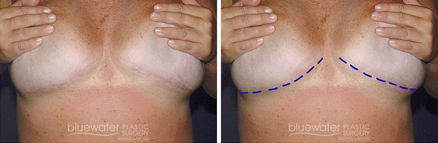 Blue Water Plastic Surgery Partners liposuction result — Raleigh, NC