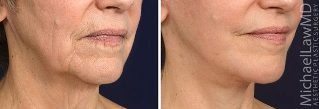 Fat Transfer result at Blue Water Plastic Surgery Partners in Raleigh, NC
