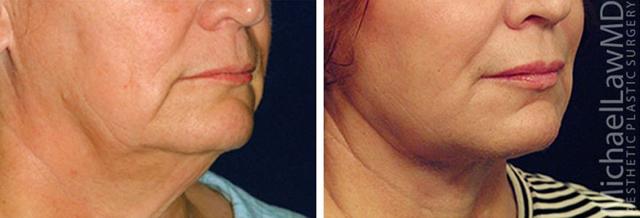Neck Lift result at Blue Water Plastic Surgery Partners in Raleigh, NC
