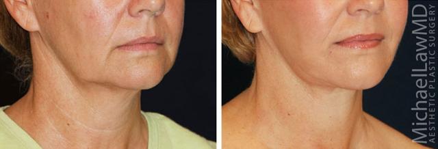 Neck Lift result at Blue Water Plastic Surgery Partners in Raleigh, NC