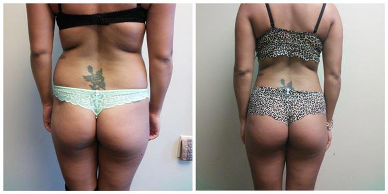 Aesthetic Surgery Institute bbl result — Houston, TX