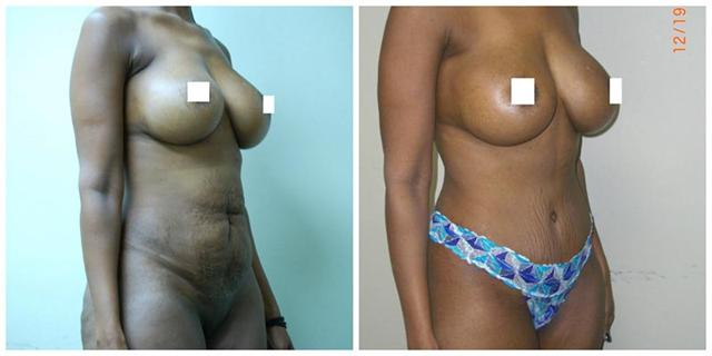 Mini Tummy Tuck result at Aesthetic Surgery Institute in Houston, TX