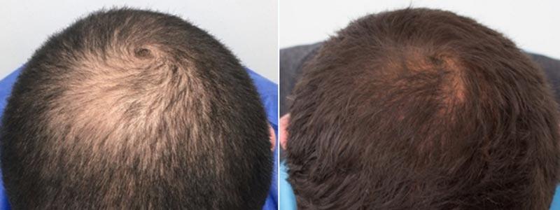 Aesthetic Surgery Institute hair restoration result — Houston, TX