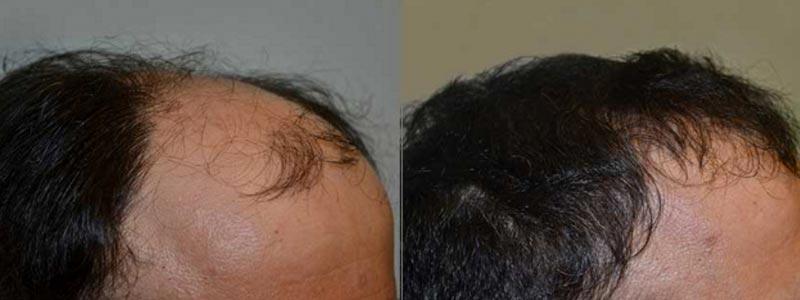 Aesthetic Surgery Institute hair restoration result — Houston, TX
