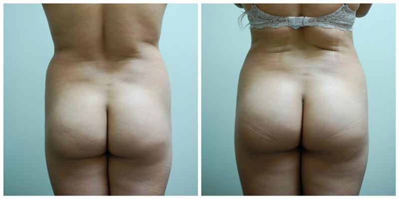 Aesthetic Surgery Institute bbl result — Houston, TX