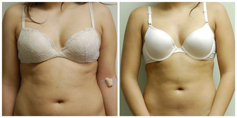 Aesthetic Surgery Institute liposuction result — Houston, TX