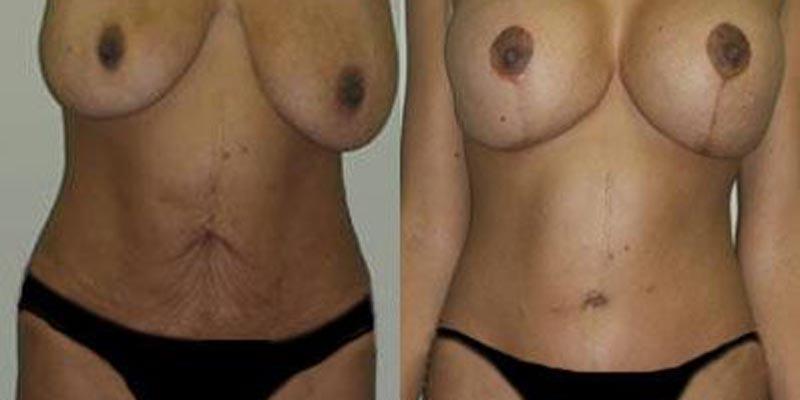 Aesthetic Surgery Institute mommy makeover result — Houston, TX