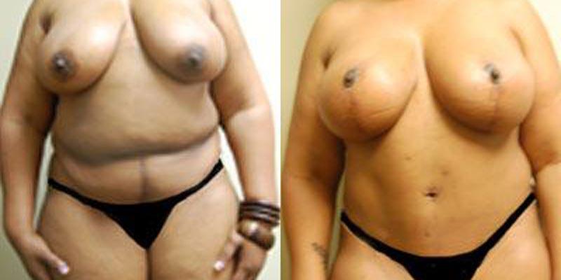 Aesthetic Surgery Institute mommy makeover result — Houston, TX