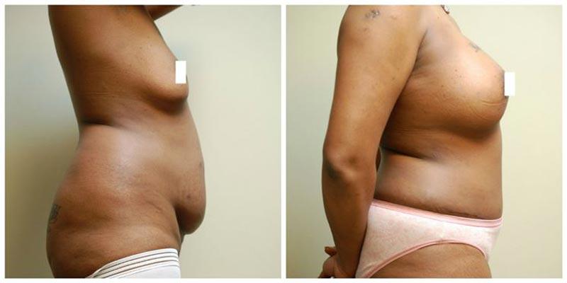 Aesthetic Surgery Institute breast augmentation result — Houston, TX