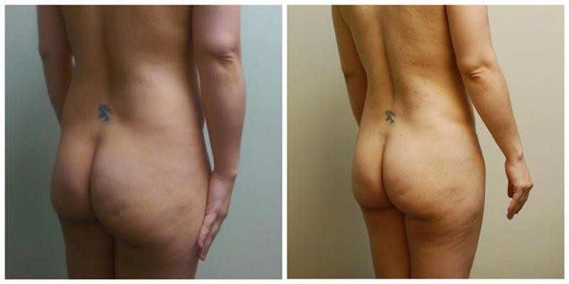 Aesthetic Surgery Institute bbl result — Houston, TX