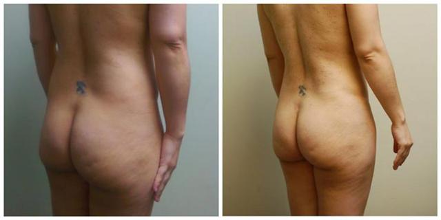 Brazilian Butt Lift result at Aesthetic Surgery Institute in Houston, TX