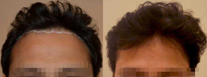 Aesthetic Surgery Institute hair restoration result — Houston, TX