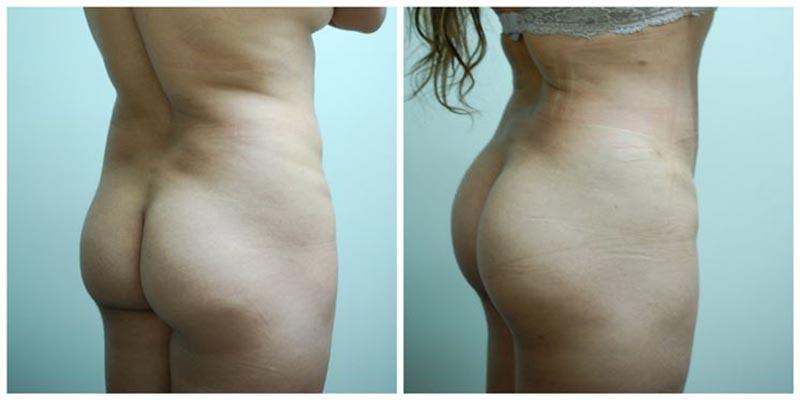 Aesthetic Surgery Institute bbl result — Houston, TX