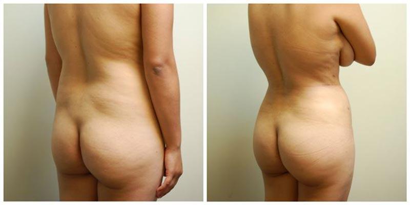 Aesthetic Surgery Institute bbl result — Houston, TX