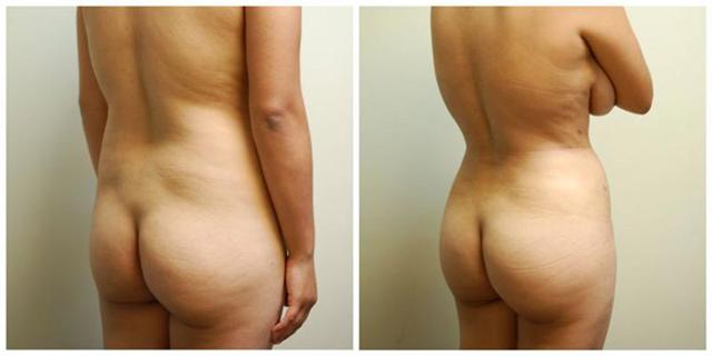 Brazilian Butt Lift result at Aesthetic Surgery Institute in Houston, TX