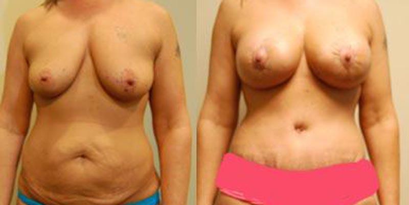 Aesthetic Surgery Institute mommy makeover result — Houston, TX