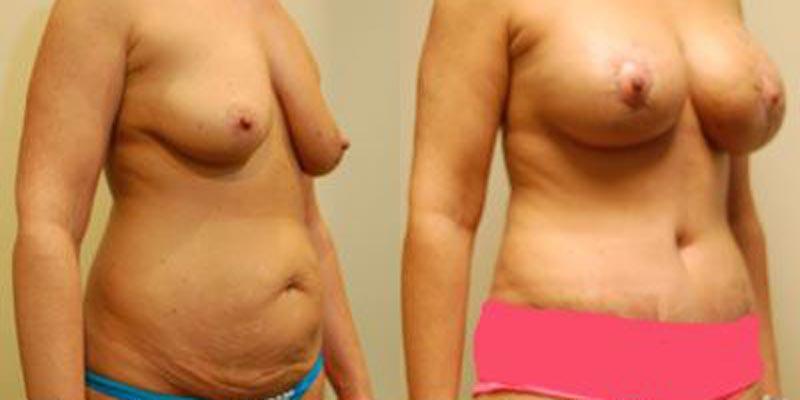 Aesthetic Surgery Institute mommy makeover result — Houston, TX