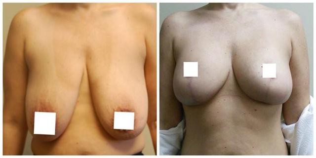 Breast Lift result at Aesthetic Surgery Institute in Houston, TX